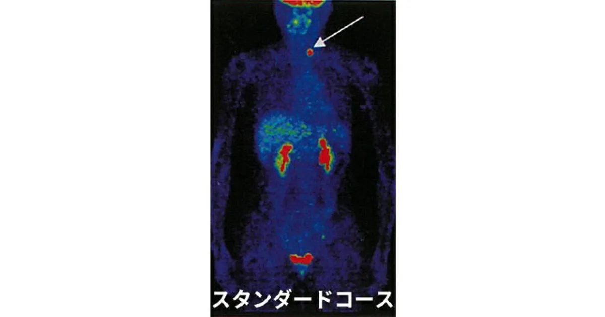 【ふるさと納税】P2 スタンダードコース　 PET-CT 腫瘍マーカー がん検診 スクリーニング検査 血液検査 肝炎 萎縮性胃炎 感染症検査 小さながん 高い 確率 早期発見 早期治療